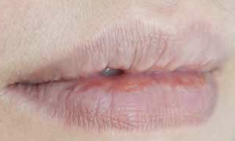 Normal Lips