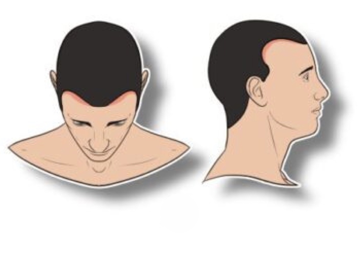 Scalp Micropigmentation level 1
