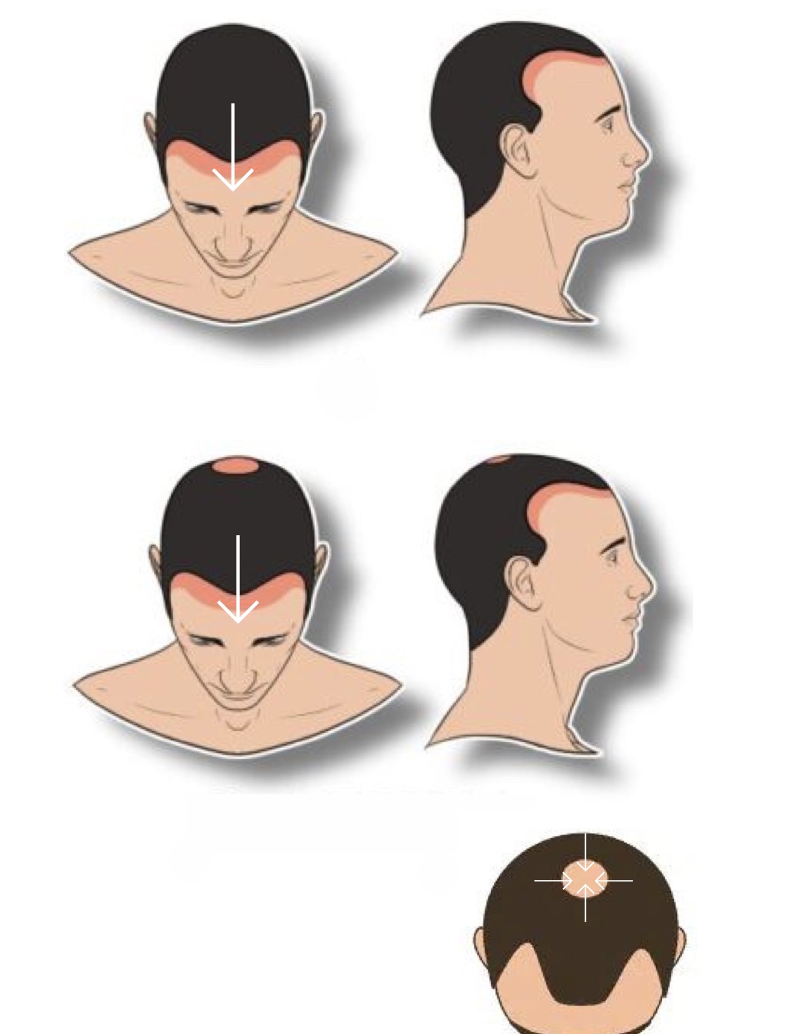 Scalp Micropigmentation level 2