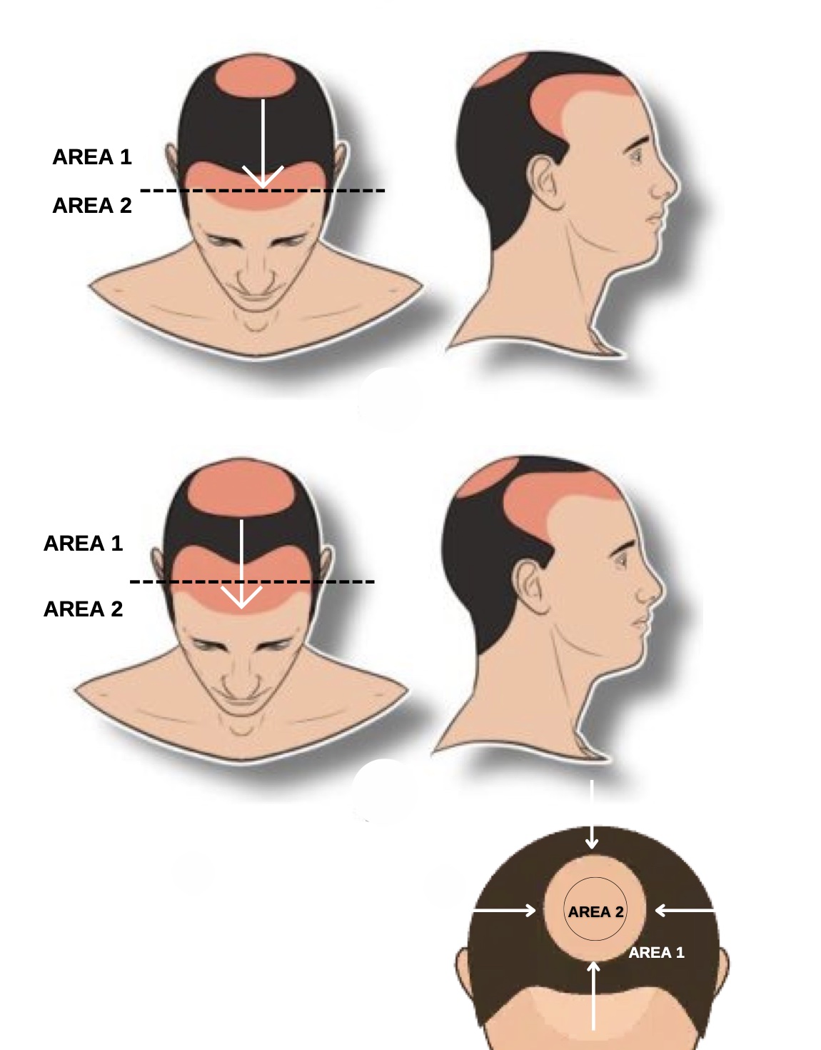 Scalp Micropigmentation level 3