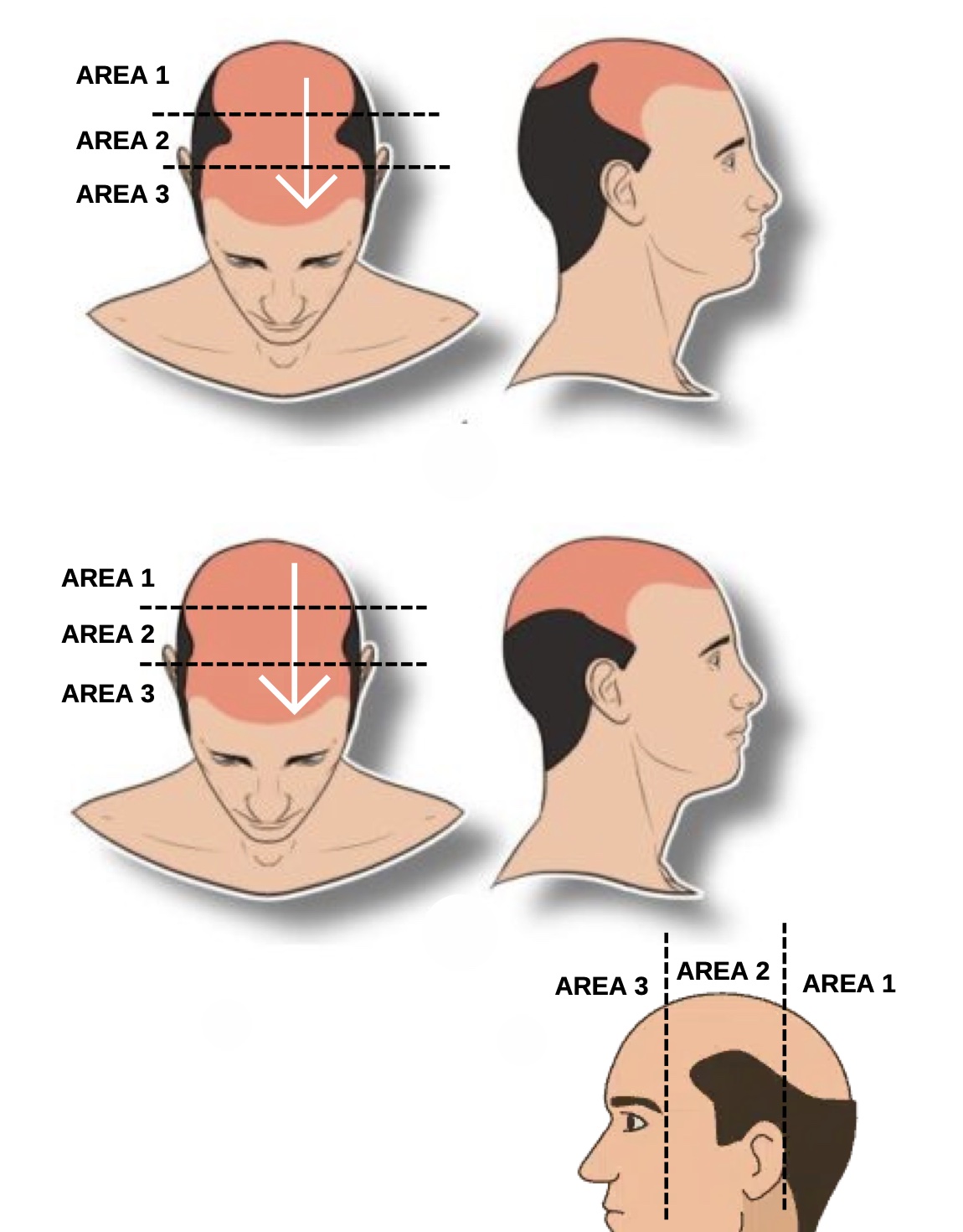 Scalp Micropigmentation level 4