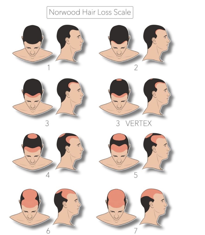 Norwood Hair Loss Scale